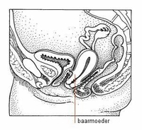 afbeelding van een verzakking van de baarmoeder