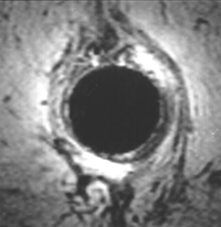 MRI afbeelding van de sluitspieren