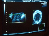 voorbeeld van een 3D-echografie